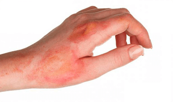 علاج الحروق وآثارها الجلدية.