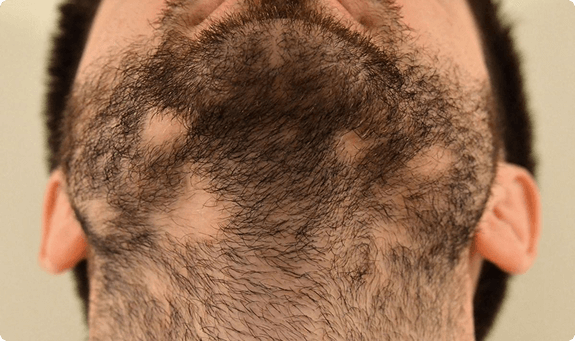 علاج الثعلبة وتساقط الشعر الموضعي