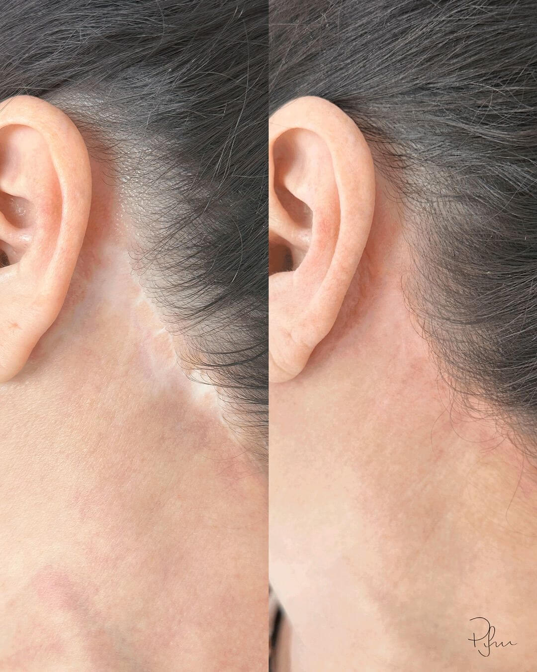 تمويه الندبات وآثار الحروق بتقنيات التجميل شبه الطبي