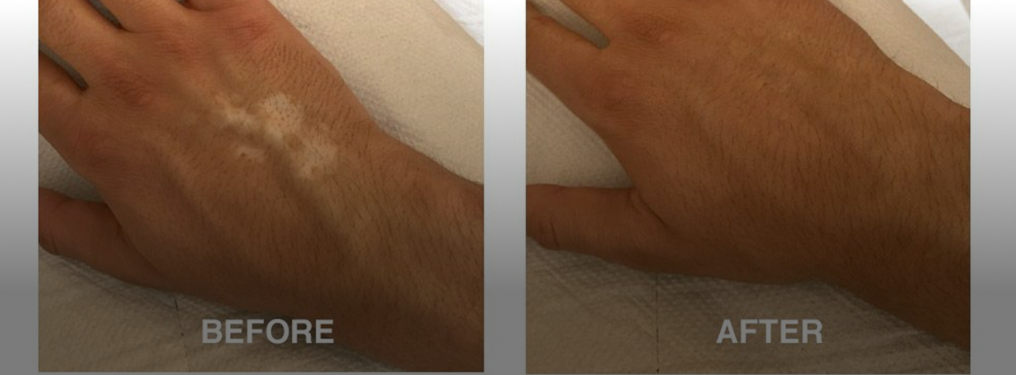 Camouflaging Inactive Vitiligo: Restoring Natural Skin Tone with Paramedical Beauty Techniques