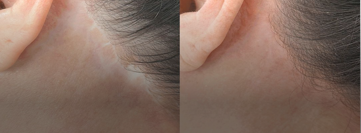 Camouflaging Scars and Burn Marks: Restoring Skin's Natural Balance with Paramedical Beauty Techniques