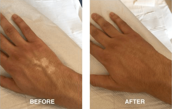 تمويه البهاق غير النشط بإستخدام تقنيات التجميل شبه الطبي