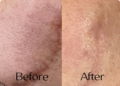 علاج ندبة قديمة باستخدام Dry Needling