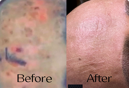 إصلاح ندوب وحروق الوجه