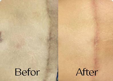 إصلاح ندبة البطن باستخدام Dry Needling
