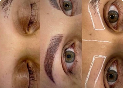 علاج الثعلبة في منطقة الحاجب (الصلع الموضعي).