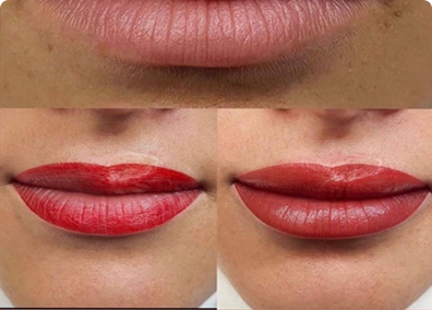 استعادة الشفاه بعد التشوه