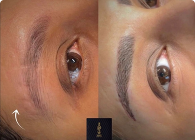 إخفاء ندبة جراحية على الحاجب