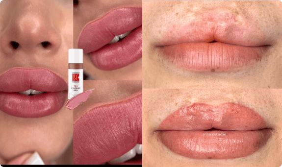 توريد وتصحيح الشفاه