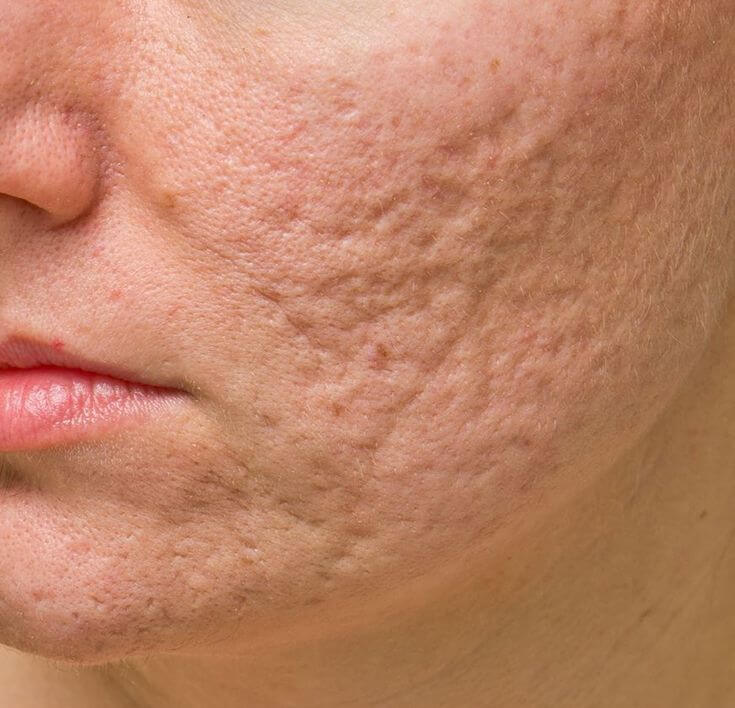 ترميم آثار حب الشباب