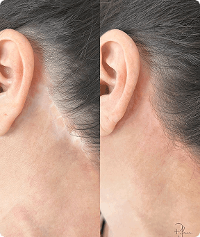 Repair of surgical and wound effects