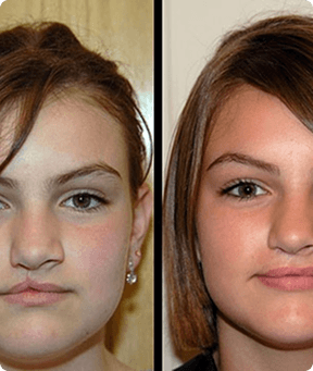 Cleft Lip Repair
