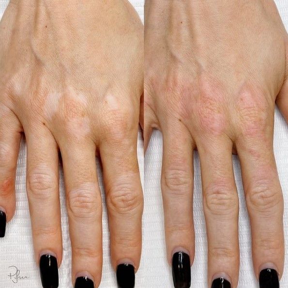 تغطية البهاق الخامل