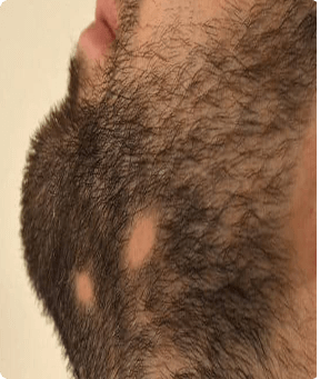Covering alopecia and localized hair loss