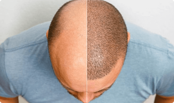 تعبئة مناطق الصلع والاقتطاف وتكثيف فروة الشعر